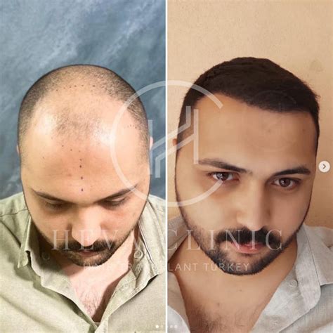 istanbul hair transplant prices.